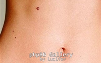 koilia-melanoma
